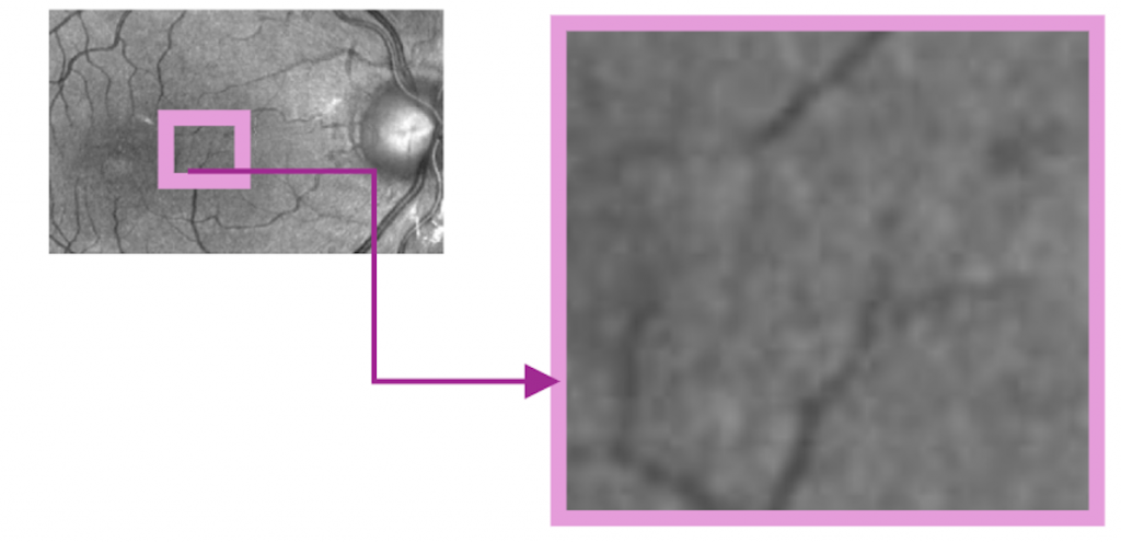 image of eye using conventional scanning laser